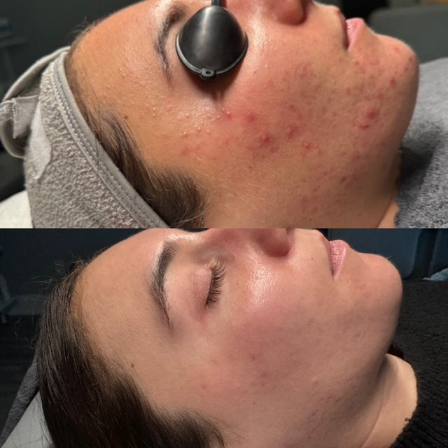 Before and after comparison of acne treatment in Bedford, NH.