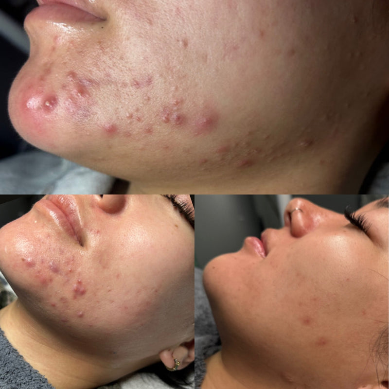 Before and after comparison of acne on a person's face.