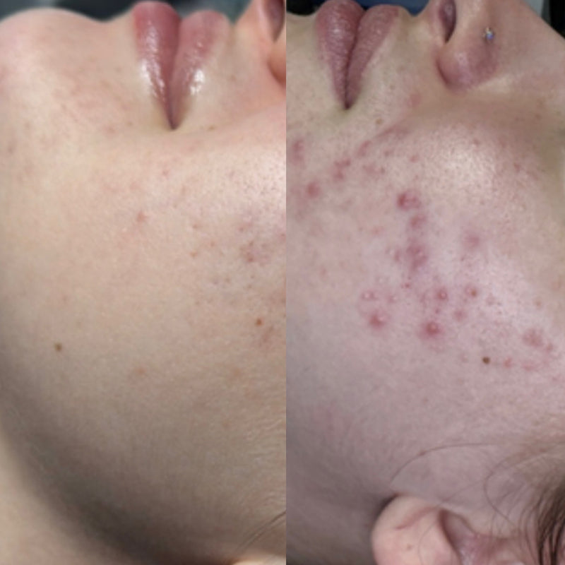 Before and after comparison of skin conditions on a person's face.